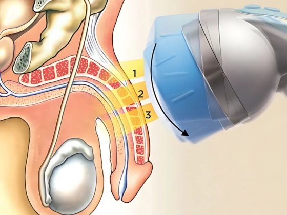 Shock Wave Therapy
