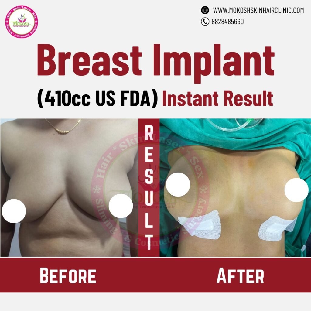 Breast Enlargement